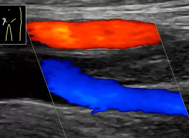 Mélyvénás alsó végtagi trombózis (comb, doppler ultrahangfelvétel)