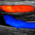 Mélyvénás alsó végtagi trombózis (comb, doppler ultrahangfelvétel)