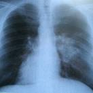 Tüdő (röntgenfelvétel)