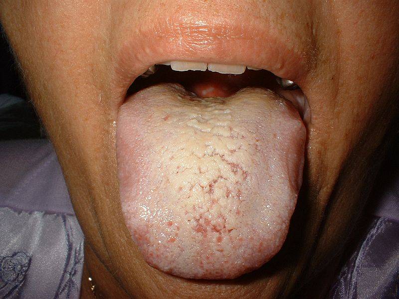 gombás papillae nyelv kezelése