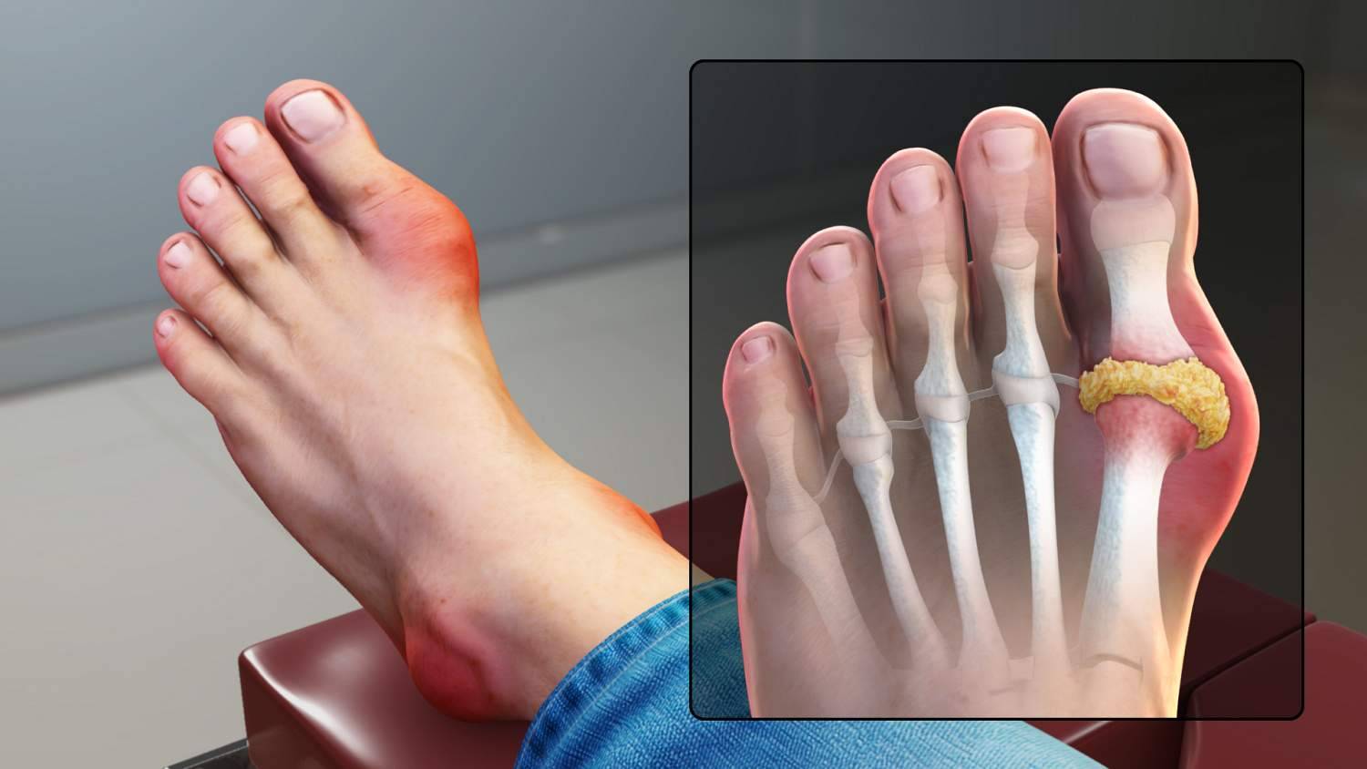 köszvénygyulladás a nagy lábujj ízületi kezelésében vállfájdalom férfiaknál