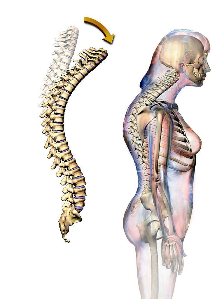 A mellkasi gerinc csontritkulása. Csontritkulás okai, kivizsgálása, kezelése - Endokrinközpont