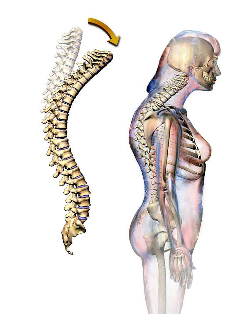 Az osteoarthritis leghatékonyabb kezelése vállízületi kenőcs