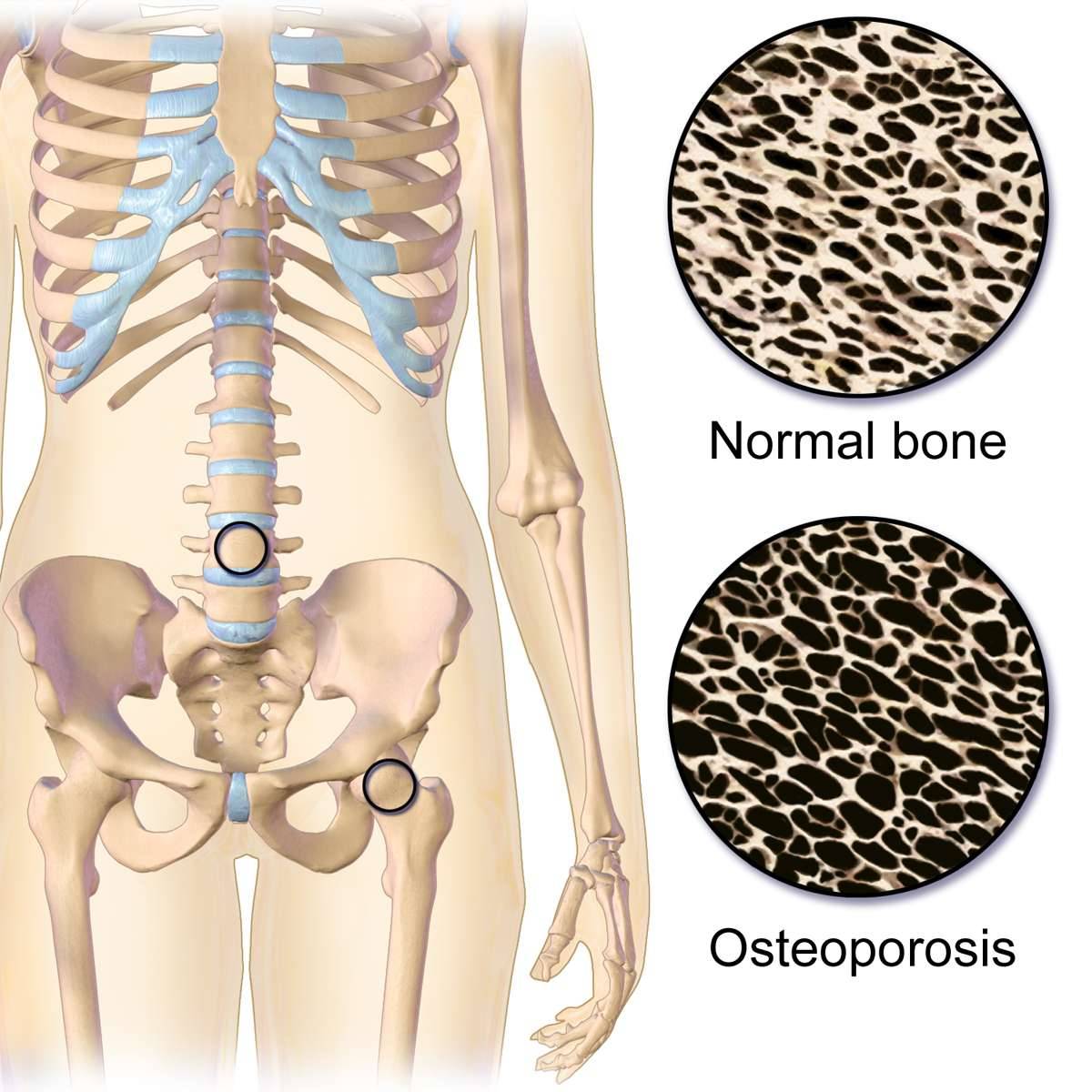 A csontritkulás (oszteoporózis) előjelei és veszélyei